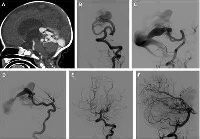 Rapid ventricular overdrive pacing and other advanced flow-control techniques for the endovascular embolization of vein of galen malformations